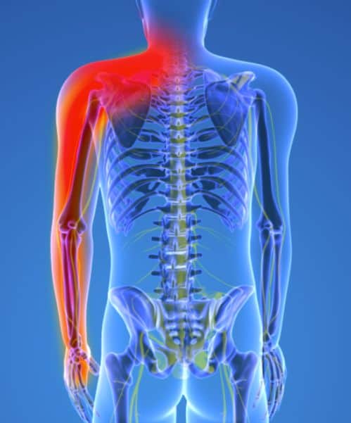 cervical radiculopathy