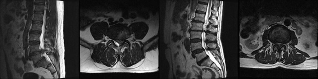 Magnetic Resonance Imaging Mri Spineplus